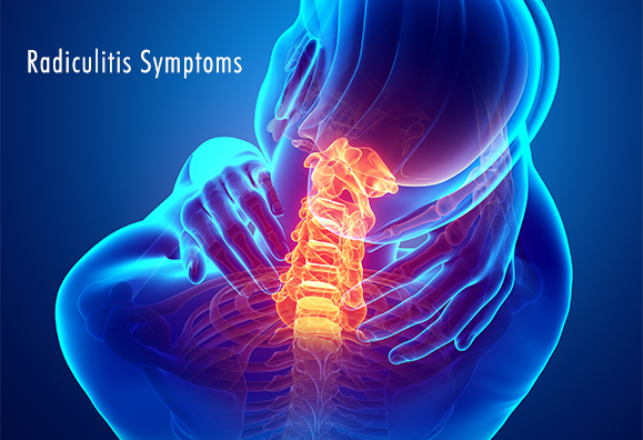 Understanding Radiculitis: Causes, Symptoms, and Treatment Options