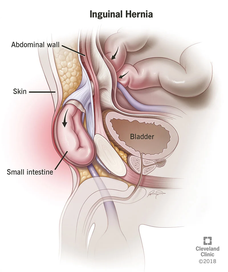 Inguinal Hernia: Symptoms, Diagnosis, and Treatment Options