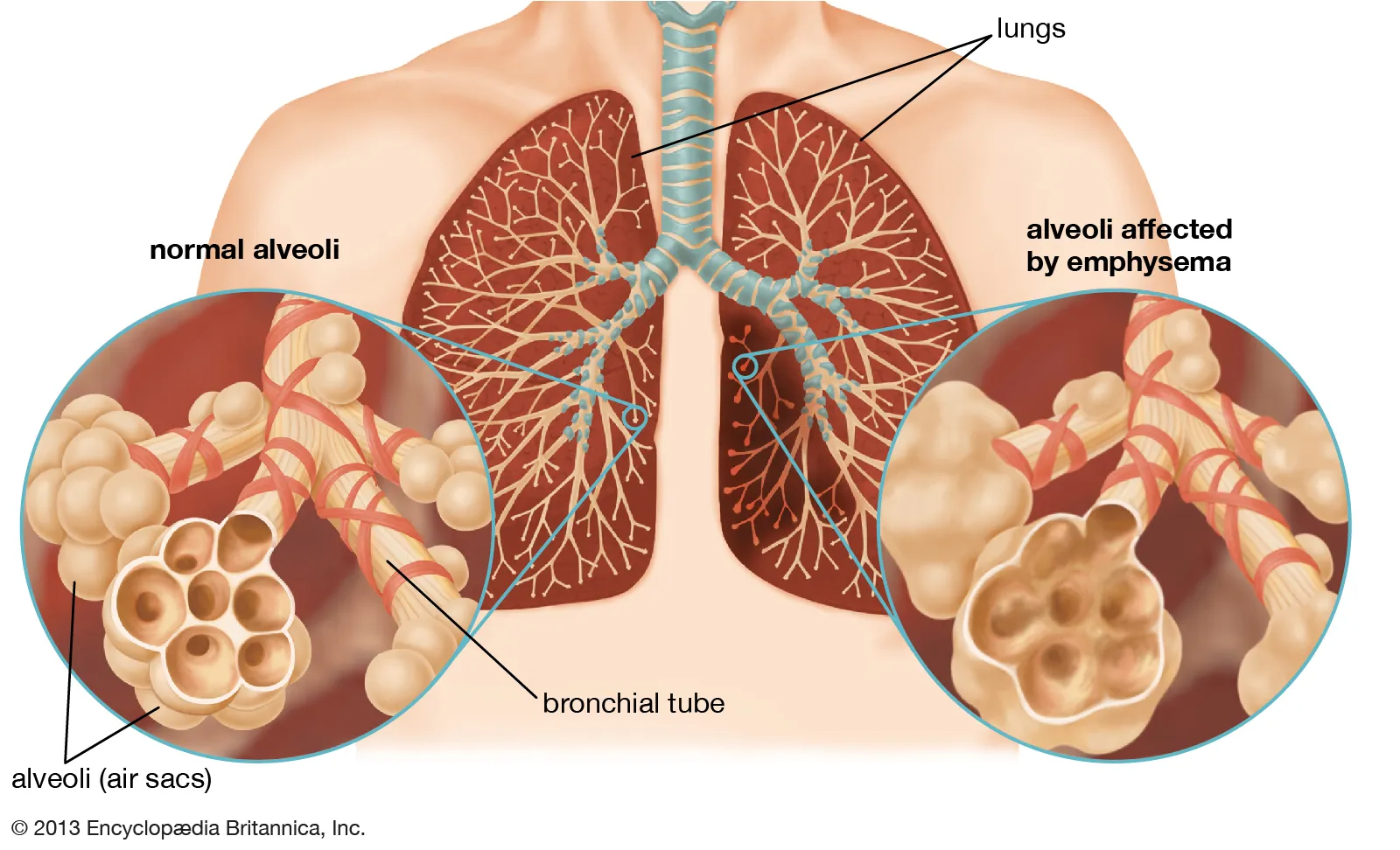 Lung disease