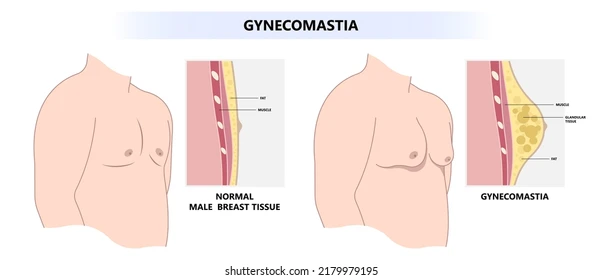 Gynecomastia