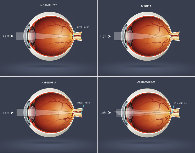 Refractive Errors